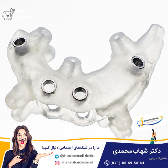 ایمپلنت فوری